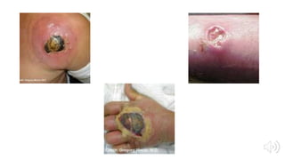 My Favorite Microbe: MRSA