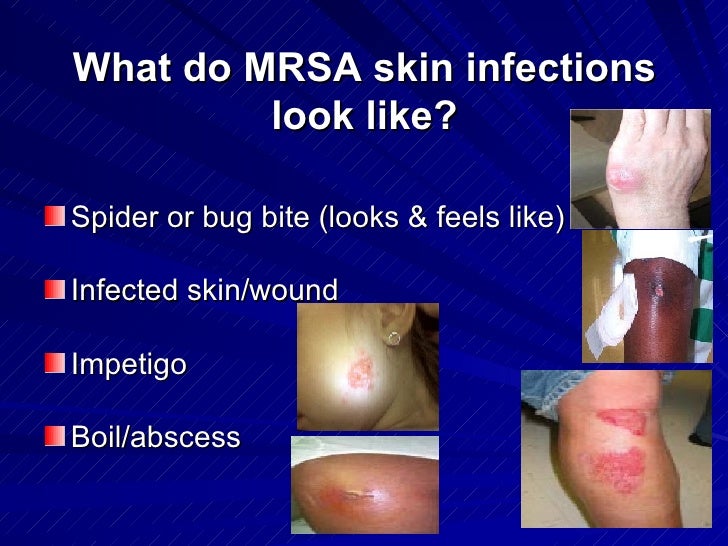 What Does A Spider Bite Feel Like Reddit / MRSA Treatment When Antibiotics Fail | Healthy Home Economist : So, what do spider bites look like—and do they itch?