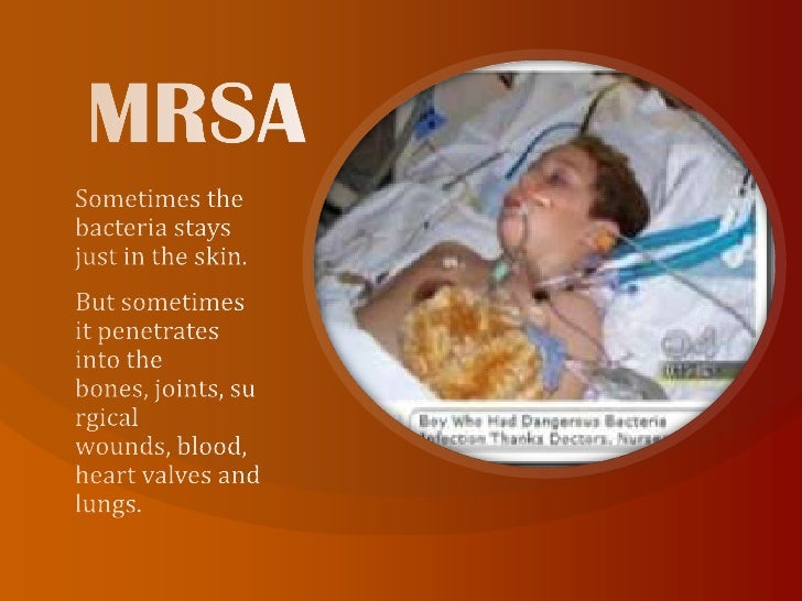 Mrsa 2009