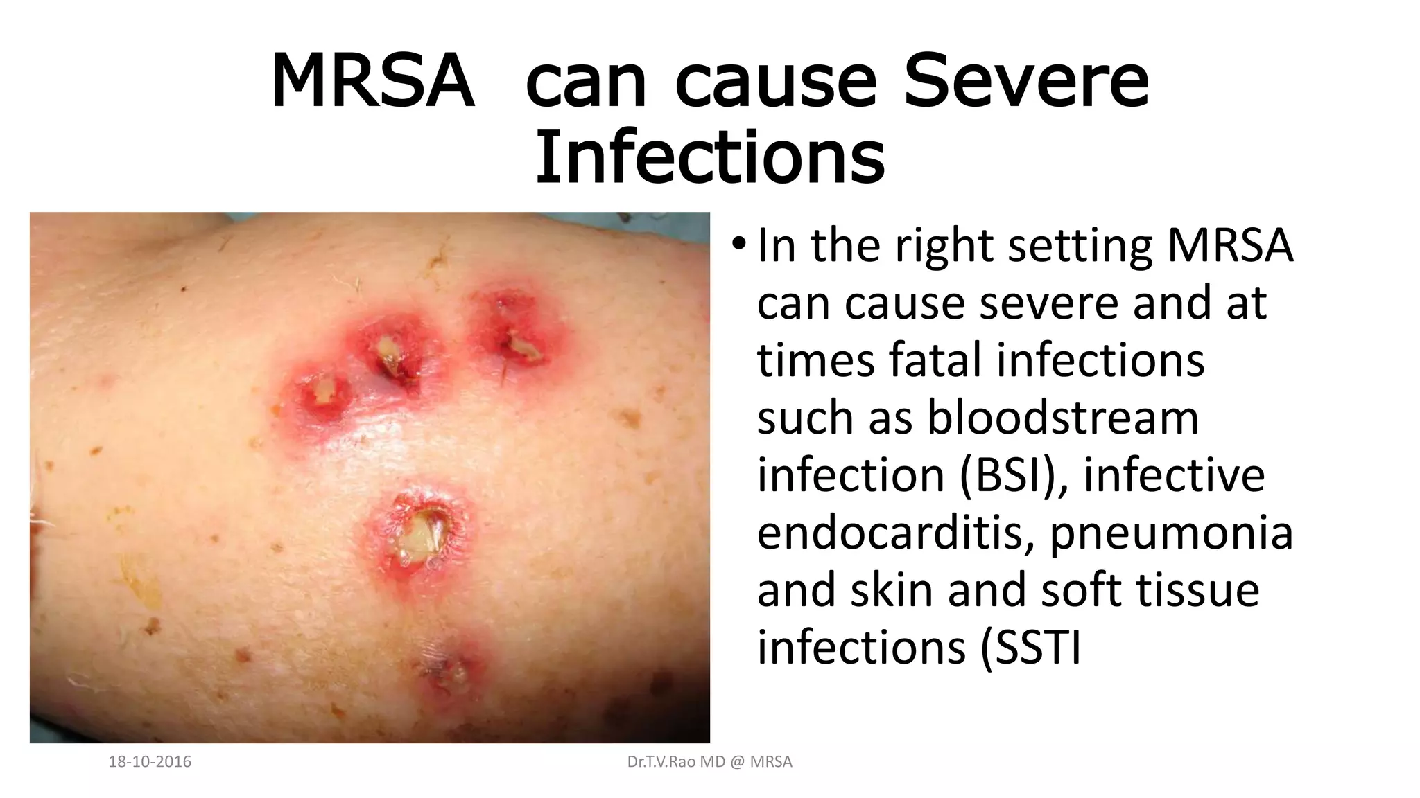 MRSA can cause Severe
Infections
•In the right setting MRSA
can cause severe and at
times fatal infections
such as bloodstream
infection (BSI), infective
endocarditis, pneumonia
and skin and soft tissue
infections (SSTI
18-10-2016 Dr.T.V.Rao MD @ MRSA
 