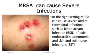 MRSA can cause Severe
Infections
•In the right setting MRSA
can cause severe and at
times fatal infections
such as bloodstream
infection (BSI), infective
endocarditis, pneumonia
and skin and soft tissue
infections (SSTI
18-10-2016 Dr.T.V.Rao MD @ MRSA
 