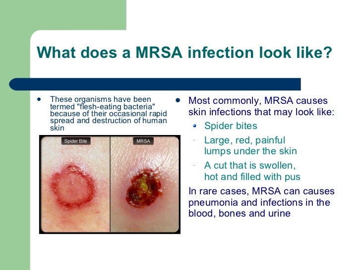 Where can you find pictures of MRSA skin infections?