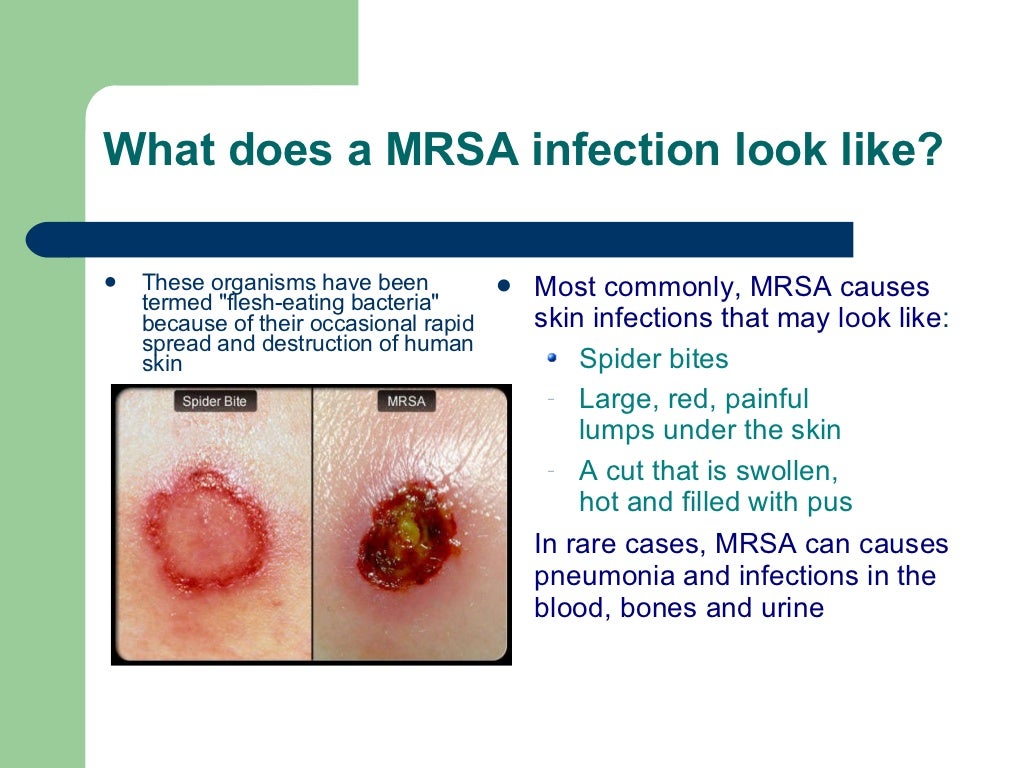 Mrsa ppt