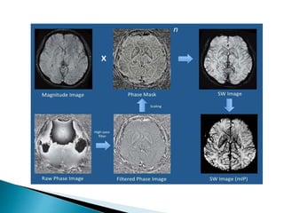 BASIC MRI SEQUENCES | PPTX