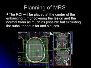 Planning of MRSPlanning of MRS
The ROI will be placed at the center of theThe ROI will be placed at the center of the
enhancing tumor covering the lesion and theenhancing tumor covering the lesion and the
normal brain as much as possible but excludingnormal brain as much as possible but excluding
the subcutaneous fat and sinuses.the subcutaneous fat and sinuses.
 