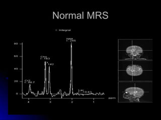 Normal MRSNormal MRS
 