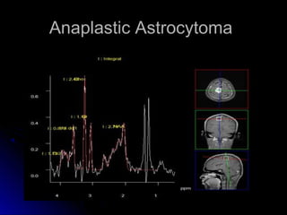 Anaplastic AstrocytomaAnaplastic Astrocytoma
 