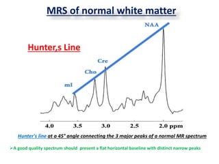 MRS of normal white matter
A good quality spectrum should present a flat horizontal baseline with distinct narrow peaks
Hunter's line at a 45° angle connecting the 3 major peaks of a normal MR spectrum
Hunter,s Line
 