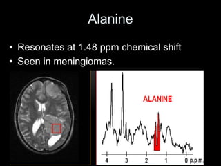 Alanine
• Resonates at 1.48 ppm chemical shift
• Seen in meningiomas.
 