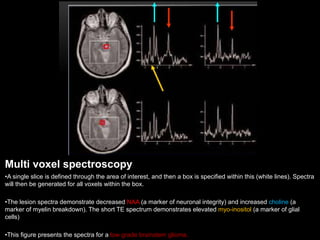 Multi voxel spectroscopy
•A single slice is defined through the area of interest, and then a box is specified within this (white lines). Spectra
will then be generated for all voxels within the box.
•The lesion spectra demonstrate decreased NAA (a marker of neuronal integrity) and increased choline (a
marker of myelin breakdown). The short TE spectrum demonstrates elevated myo-inositol (a marker of glial
cells)
•This figure presents the spectra for a low grade brainstem glioma.
 
