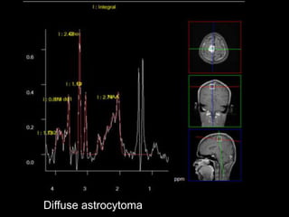Diffuse astrocytoma
 