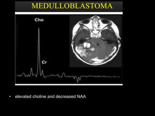• elevated choline and decreased NAA
 