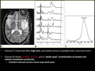 • Volume 21 shows low NAA, high Cho, and lactate (arrow) compatible with a recurrent tumor
• Volume 24 shows no NAA, low Cho, and a “death peak” (combination of lactate and
cellular breakdown products).
– Radiation-induced necrosis shows large death peak.
 