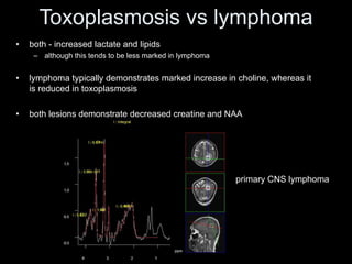 Toxoplasmosis vs lymphoma
• both - increased lactate and lipids
– although this tends to be less marked in lymphoma
• lymphoma typically demonstrates marked increase in choline, whereas it
is reduced in toxoplasmosis
• both lesions demonstrate decreased creatine and NAA
primary CNS lymphoma
 