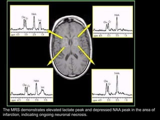 The MRS demonstrates elevated lactate peak and depressed NAA peak in the area of
infarction, indicating ongoing neuronal necrosis.
 