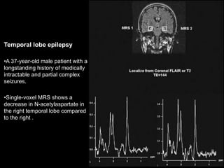 Temporal lobe epilepsy
•A 37-year-old male patient with a
longstanding history of medically
intractable and partial complex
seizures.
•Single-voxel MRS shows a
decrease in N-acetylaspartate in
the right temporal lobe compared
to the right .
 