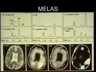 MELAS
 