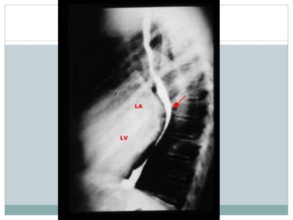 mitral stenosis AHA guidlines 2014