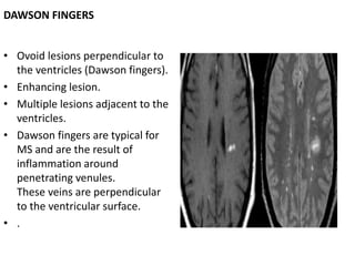 Multiple Sclerosis Mri Dawsons Fingers