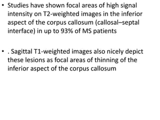 • Studies have shown focal areas of high signal
intensity on T2-weighted images in the inferior
aspect of the corpus callosum (callosal–septal
interface) in up to 93% of MS patients
• . Sagittal T1-weighted images also nicely depict
these lesions as focal areas of thinning of the
inferior aspect of the corpus callosum
 