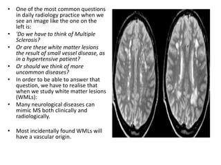 • One of the most common questions
in daily radiology practice when we
see an image like the one on the
left is:
• 'Do we have to think of Multiple
Sclerosis?
• Or are these white matter lesions
the result of small vessel disease, as
in a hypertensive patient?
• Or should we think of more
uncommon diseases?
• In order to be able to answer that
question, we have to realise that
when we study white matter lesions
(WMLs):
• Many neurological diseases can
mimic MS both clinically and
radiologically.
• Most incidentally found WMLs will
have a vascular origin.
 
