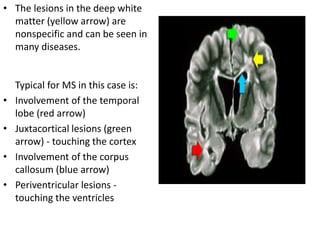 • The lesions in the deep white
matter (yellow arrow) are
nonspecific and can be seen in
many diseases.
Typical for MS in this case is:
• Involvement of the temporal
lobe (red arrow)
• Juxtacortical lesions (green
arrow) - touching the cortex
• Involvement of the corpus
callosum (blue arrow)
• Periventricular lesions -
touching the ventricles
 