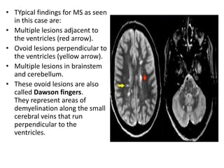 • TYpical findings for MS as seen
in this case are:
• Multiple lesions adjacent to
the ventricles (red arrow).
• Ovoid lesions perpendicular to
the ventricles (yellow arrow).
• Multiple lesions in brainstem
and cerebellum.
• These ovoid lesions are also
called Dawson fingers.
They represent areas of
demyelination along the small
cerebral veins that run
perpendicular to the
ventricles.
 