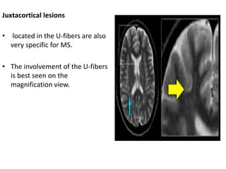 Juxtacortical lesions
• located in the U-fibers are also
very specific for MS.
• The involvement of the U-fibers
is best seen on the
magnification view.
 