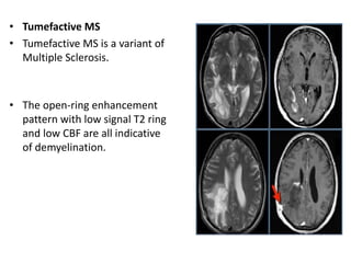• Tumefactive MS
• Tumefactive MS is a variant of
Multiple Sclerosis.
• The open-ring enhancement
pattern with low signal T2 ring
and low CBF are all indicative
of demyelination.
 