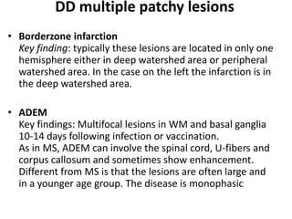 DD multiple patchy lesions
• Borderzone infarction
Key finding: typically these lesions are located in only one
hemisphere either in deep watershed area or peripheral
watershed area. In the case on the left the infarction is in
the deep watershed area.
• ADEM
Key findings: Multifocal lesions in WM and basal ganglia
10-14 days following infection or vaccination.
As in MS, ADEM can involve the spinal cord, U-fibers and
corpus callosum and sometimes show enhancement.
Different from MS is that the lesions are often large and
in a younger age group. The disease is monophasic
 