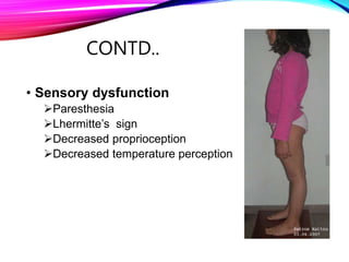 CONTD..
• Sensory dysfunction
Paresthesia
Lhermitte’s sign
Decreased proprioception
Decreased temperature perception
 