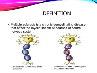 DEFINITION
• Multiple sclerosis is a chronic demyelinating disease
that affect the myelin sheath of neurons of central
nervous system.
 