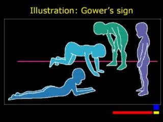 Gets up climbing up his legs- Gower’s sign
 