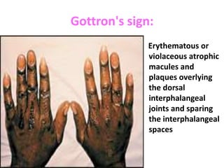 Gottron's sign:
              Erythematous or
              violaceous atrophic
              macules and
              plaques overlying
              the dorsal
              interphalangeal
              joints and sparing
              the interphalangeal
              spaces
 