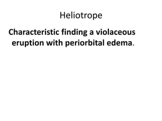 Heliotrope
Characteristic finding a violaceous
 eruption with periorbital edema.
 
