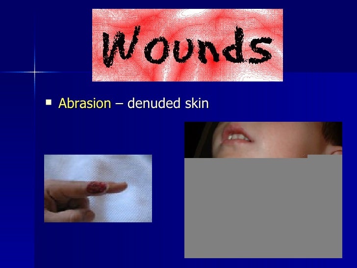 Denuded wound Nude Photos 45 Denuded wound Nude Photos 59