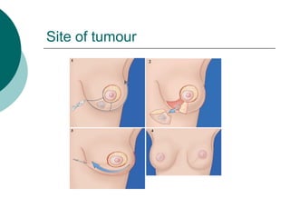 Site of tumour
 