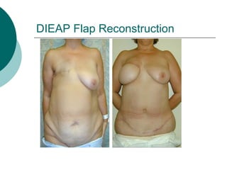 DIEAP Flap Reconstruction
 