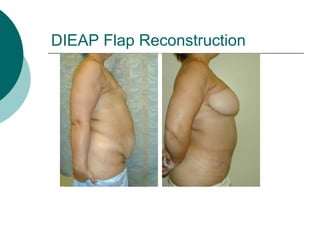 DIEAP Flap Reconstruction
 