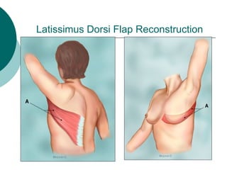 Latissimus Dorsi Flap Reconstruction
 
