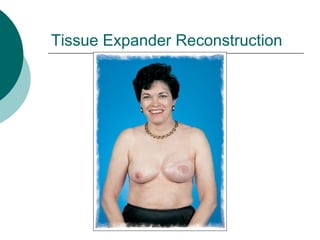 Tissue Expander Reconstruction
 
