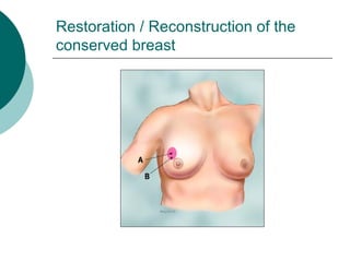 Restoration / Reconstruction of the
conserved breast
 