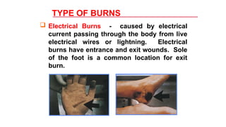 Electric Burn Example MS3-MIDTERM-TOPICS-BURNS-FIRST-AID-AND-PRINCIPLES-OF-MOVING-VICTIMS-OR ...