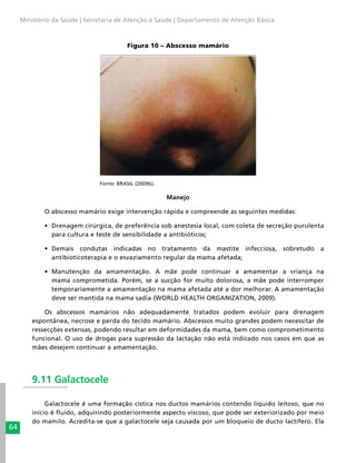 64
Ministério da Saúde | Secretaria de Atenção à Saúde | Departamento de Atenção Básica
Figura 10 – Abscesso mamário
			Fonte: BRASIL (2009b).
Manejo
O abscesso mamário exige intervenção rápida e compreende as seguintes medidas:
•	 Drenagem cirúrgica, de preferência sob anestesia local, com coleta de secreção purulenta
para cultura e teste de sensibilidade a antibióticos;
•	 Demais condutas indicadas no tratamento da mastite infecciosa, sobretudo a
antibioticoterapia e o esvaziamento regular da mama afetada;
•	 Manutenção da amamentação. A mãe pode continuar a amamentar a criança na
mama comprometida. Porém, se a sucção for muito dolorosa, a mãe pode interromper
temporariamente a amamentação na mama afetada até a dor melhorar. A amamentação
deve ser mantida na mama sadia (WORLD HEALTH ORGANIZATION, 2009).
Os abscessos mamários não adequadamente tratados podem evoluir para drenagem
espontânea, necrose e perda do tecido mamário. Abscessos muito grandes podem necessitar de
ressecções extensas, podendo resultar em deformidades da mama, bem como comprometimento
funcional. O uso de drogas para supressão da lactação não está indicado nos casos em que as
mães desejem continuar a amamentação.
9.11 Galactocele
Galactocele é uma formação cística nos ductos mamários contendo líquido leitoso, que no
início é fluido, adquirindo posteriormente aspecto viscoso, que pode ser exteriorizado por meio
do mamilo. Acredita-se que a galactocele seja causada por um bloqueio de ducto lactífero. Ela
 