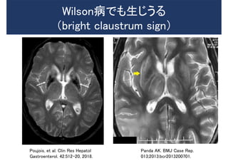 Poujois, et al. Clin Res Hepatol
Gastroenterol. 42:512-20, 2018.
Wilson病でも生じうる
（bright claustrum sign）
Panda AK. BMJ Case Rep.
013;2013:bcr2013200701.
 
