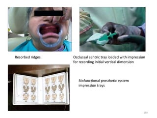 159
Resorbed ridges Occlussal centric tray loaded with impression
for recording initial vertical dimension
Biofunctional prosthetic system
impression trays
 
