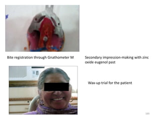 160
Bite registration through Gnathometer M Secondary impression-making with zinc
oxide eugenol past
Wax-up trial for the patient
 