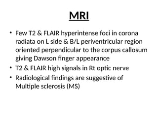 Multiple Sclerosis Case presentation .pptx