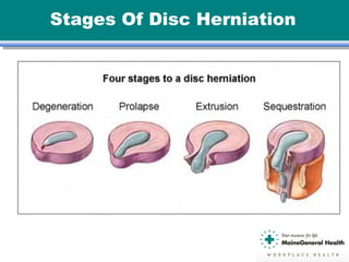 Stages Of Disc Herniation
 