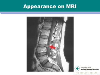 Appearance on MRI
 